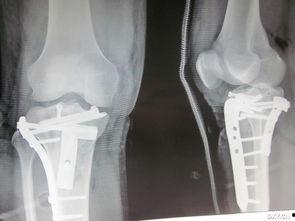 成人胫骨牵引图片视频,成人胫骨牵引技术解析与实操演示